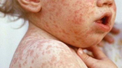 Se detectaron 128 casos de sarampión en el Conurbano