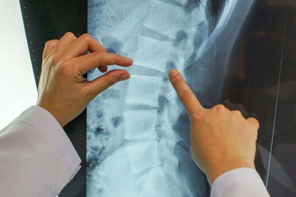 Mielitis transversa: qu es lo que habra frenado la vacuna de Oxford contra el coronavirus