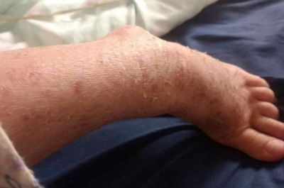 La pandemia agrav� la situaci�n de las personas con dermatitis at�pica