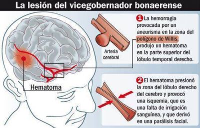 Los planes de Balestrini antes de sufrir el accidente cerebrovascular