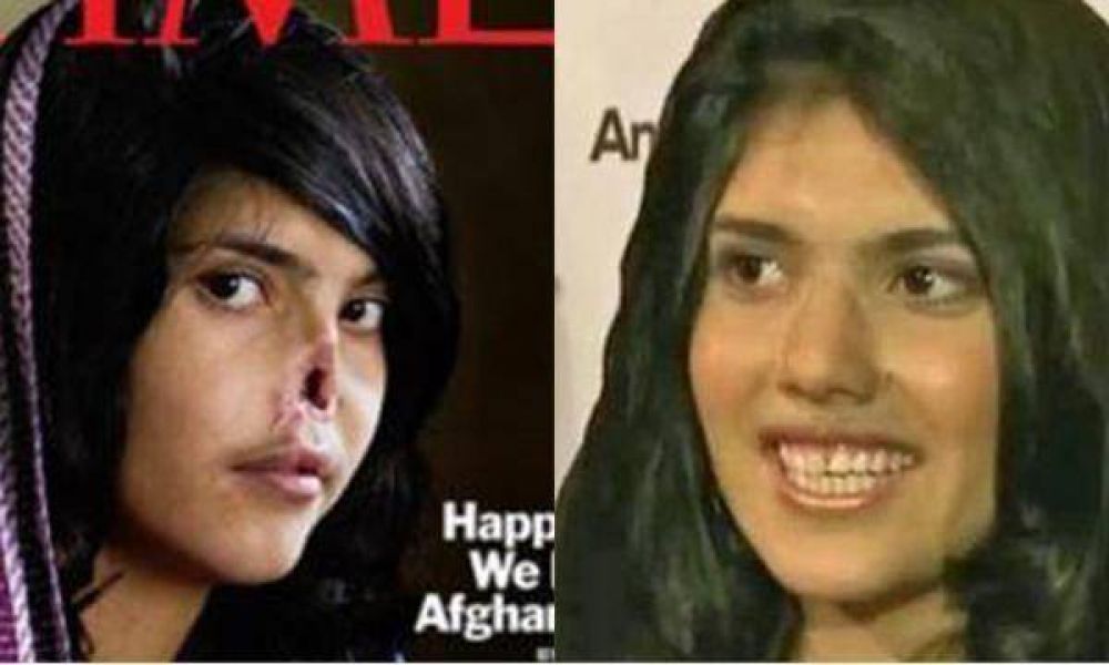 El antes y el despu�s de la joven afgana sin nariz