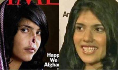 El antes y el despu�s de la joven afgana sin nariz