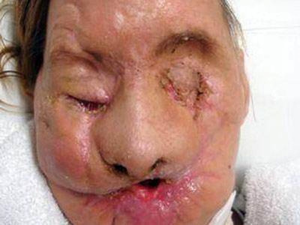 Se recupera mujer a la que le trasplantaron el rostro