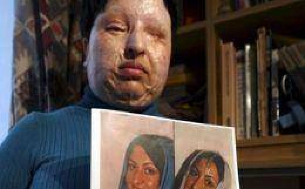 Iran� desfigurada con �cido renuncia a venganza de "ojo por ojo"