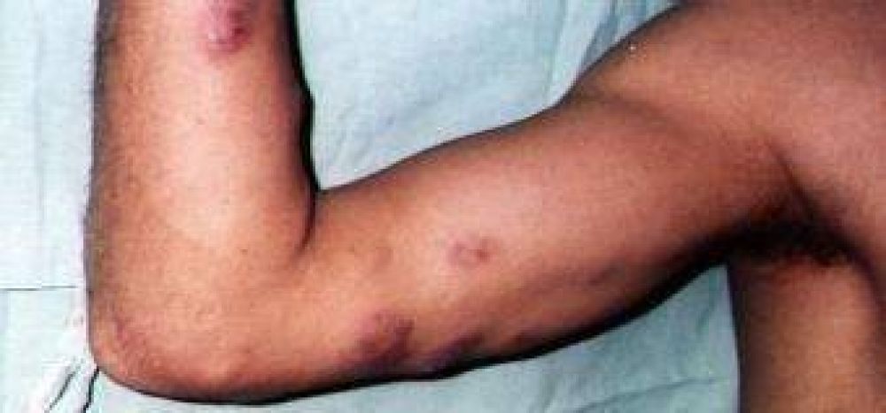 Riesgo de epidemia con la leishmaniasis.