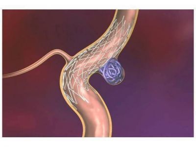 Se efectu� una innovadora neurocirug�a en Concepci�n del Uruguay