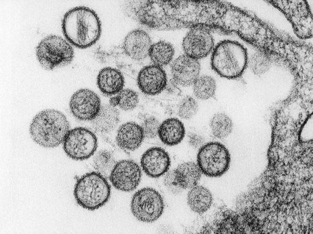 Virus mortal alarma a 10.000 posibles infectados
