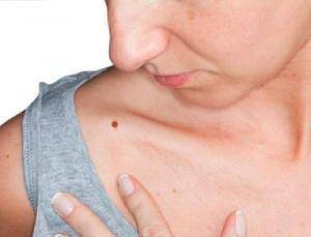 Detecci�n gratuita de c�ncer de piel