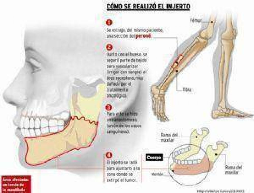 Con el peron� le reconstruyen la cara 