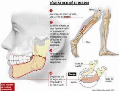 Con el peron� le reconstruyen la cara 