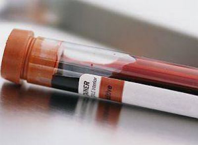 Preocupan los diagn�sticos tard�os de VIH