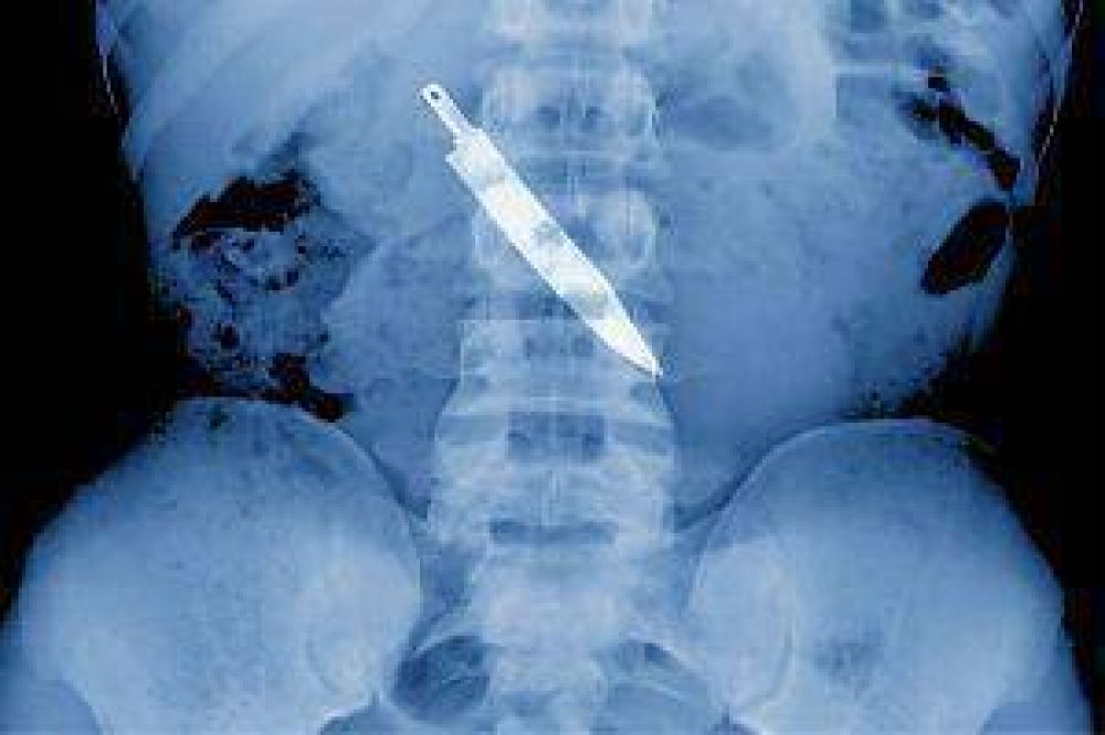 Despechado se trag� la hoja de un cuchillo y est� grave 