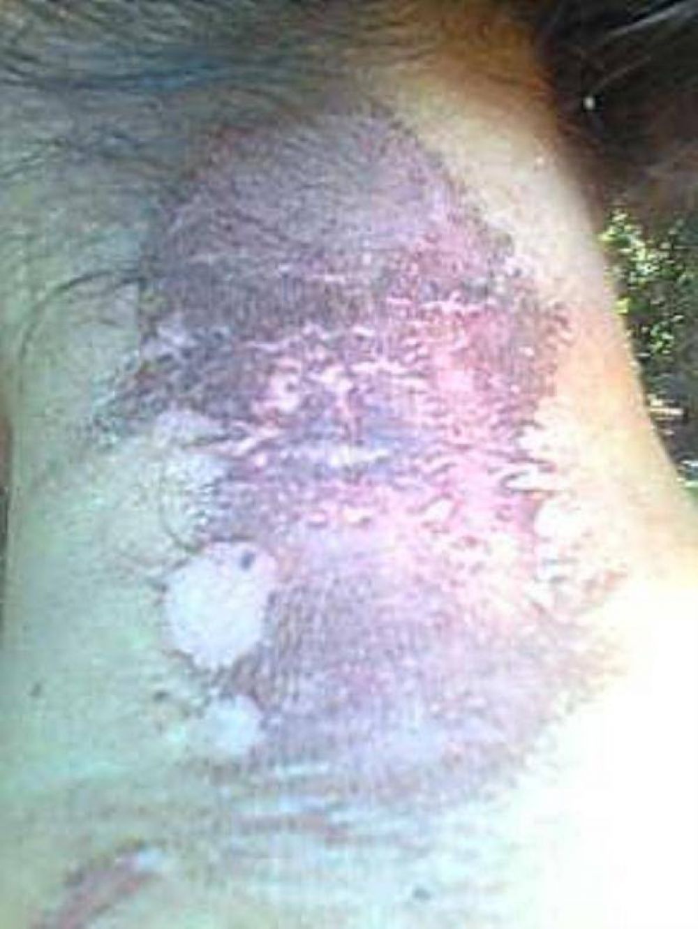 Ven�a a Misiones y le pic� un gusano de ficus dentro del micro