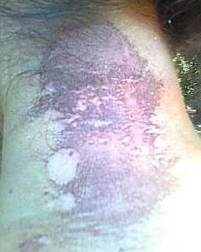 Ven�a a Misiones y le pic� un gusano de ficus dentro del micro