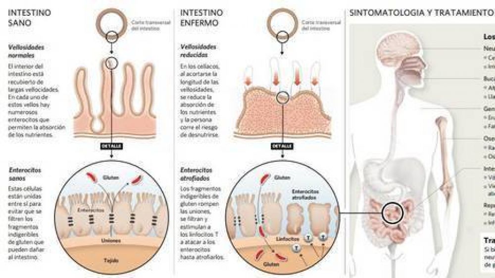Celiaqu�a: crecen los casos y dicen que ya es una enfermedad popular