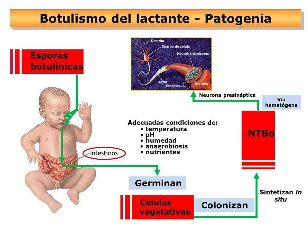 Por a�o, se registran entre seis y siete casos de botulismo en nuestra ciudad