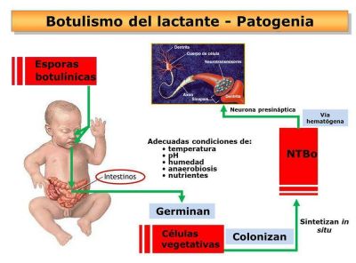 Por a�o, se registran entre seis y siete casos de botulismo en nuestra ciudad