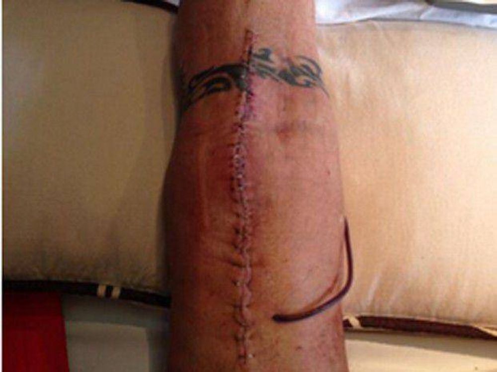 | As� est� la rodilla de Ricardo Fort tras la operaci�n