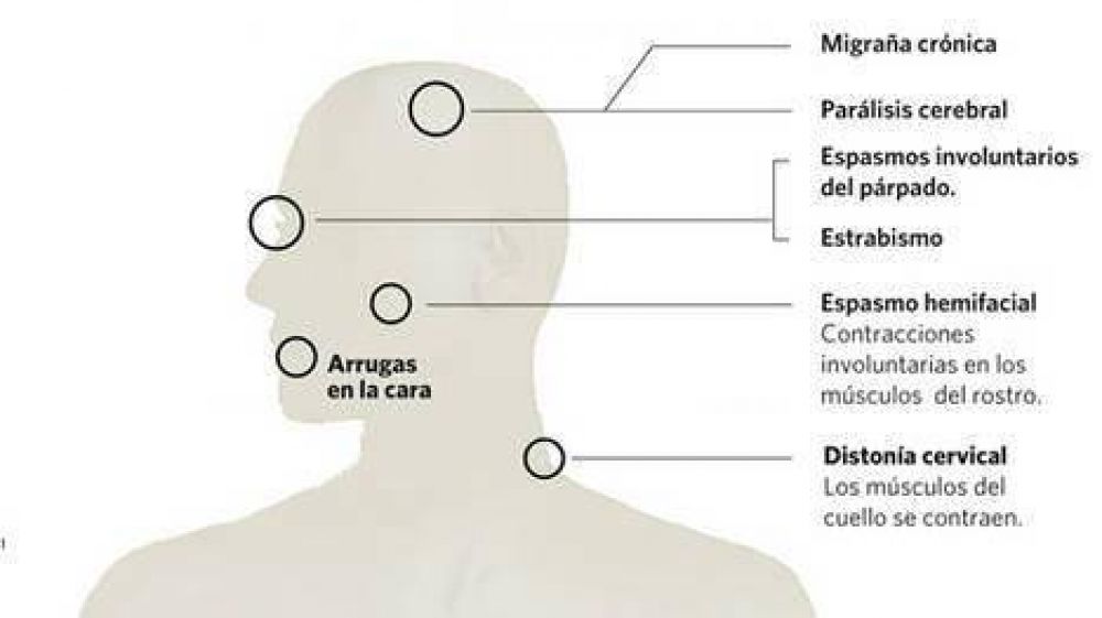 El Botox sigue creciendo:ya suma 10 aplicaciones para el cuerpo humano