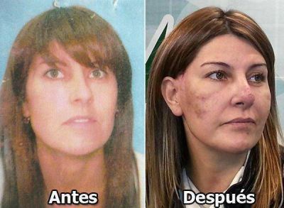 Mala praxis: denunci� que una m�dica le arruin� la cara