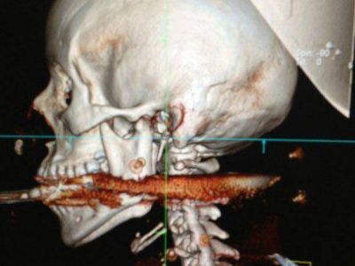 Mujer fue atravesada por un arp�n y sobrevivi�