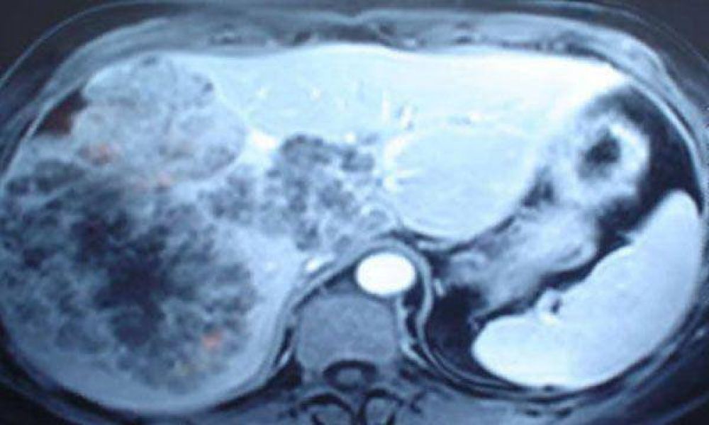 Extirpan un tumor de 25 kilos a una mujer en un hospital p�blico de Haedo