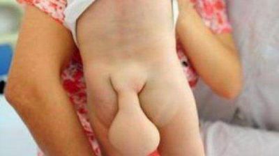 Conmoci�n por un bebe chino que tiene una "cola de castor"