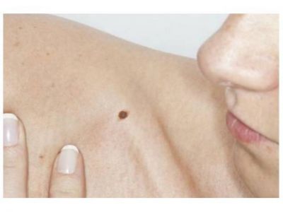 Aumentaron los casos de c�ncer de piel en Entre R�os
