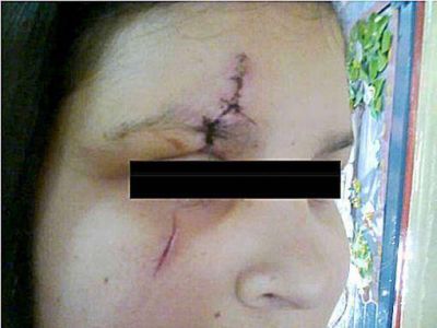 Una adolescente casi le saca un ojo a otra por ataque con un cortaplumas 