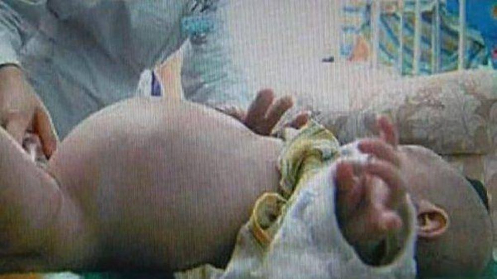 Ni�o de 2 a�os estuvo "embarazado" de su hermano mellizo