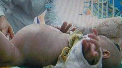 Ni�o de 2 a�os estuvo "embarazado" de su hermano mellizo