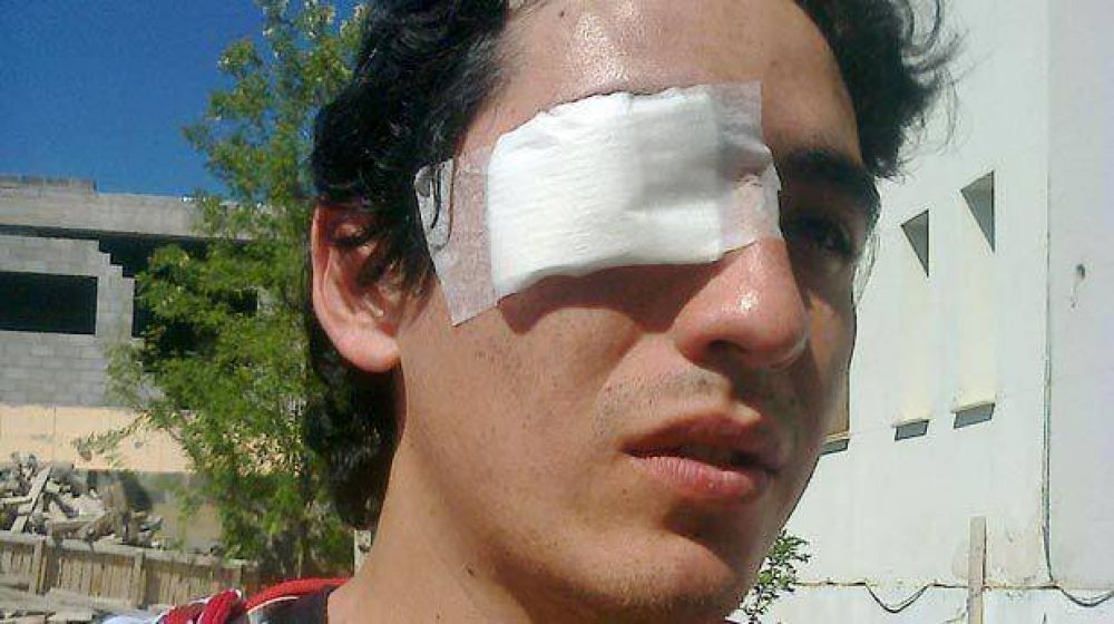 Un polic�a lo bale� en el ojo derecho y corre riesgo de perder la visi�n