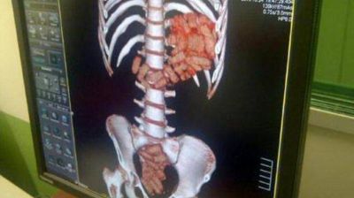 Iba a Europa: joven paraguaya se trag� 50 c�psulas de coca�na