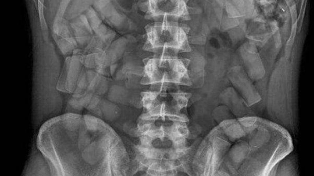 Se le estall� una c�psula con droga en el est�mago