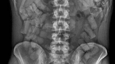 Se le estall� una c�psula con droga en el est�mago