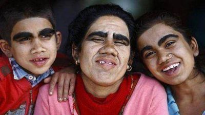 Una familia super� con �xito el "s�ndrome del hombre lobo"