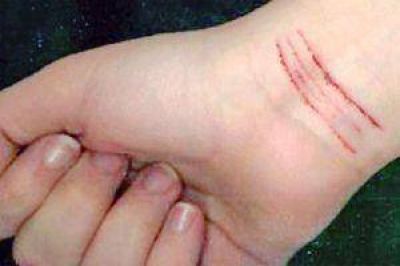 Conmoci�n por una alumna que se hizo cortes en los brazos en el aula